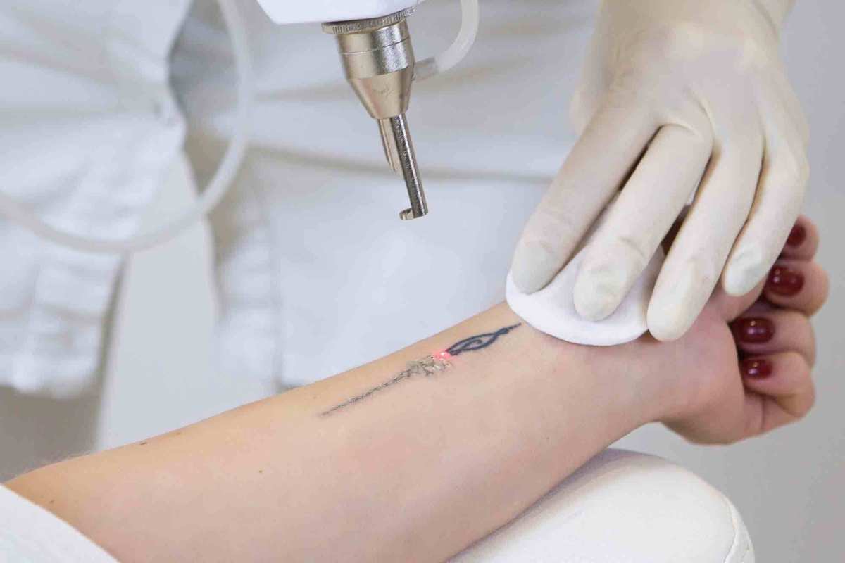 Why Laser Tattoo Removal Is Th 2086 2196 1600833484