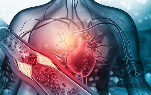 cholesterol cao la yeu to nguy co cua benh tim mach