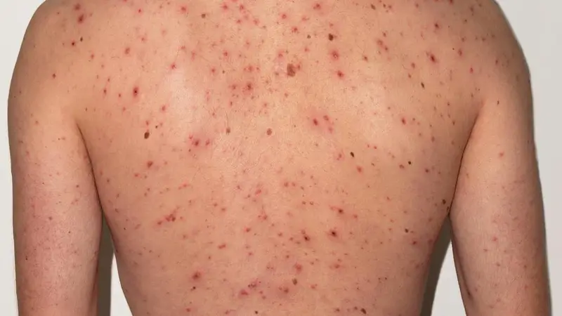 cach tri mun lung cho nam hieu qua bat ngo 7 c42a9b6585