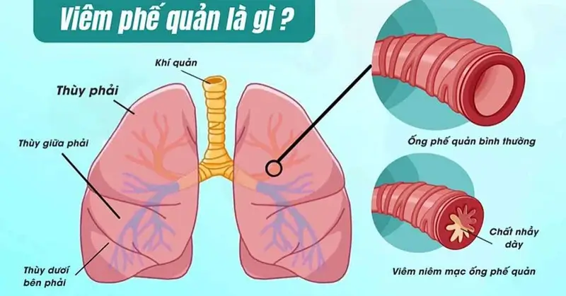 viem tieu phe quan khac viem phe quan the nao o tre em 1 5bba0387d1